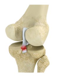 Ligament Injuries