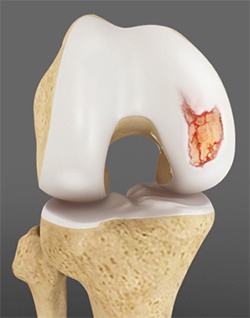 Osteoarthritis (OA)