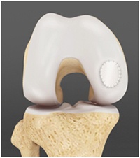 Osteochondral Grafting