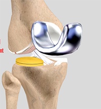 Unicompartmental Knee Replacement